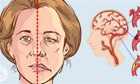 A Month Before Stroke Your Body Will Warn You With These 10 Signals
