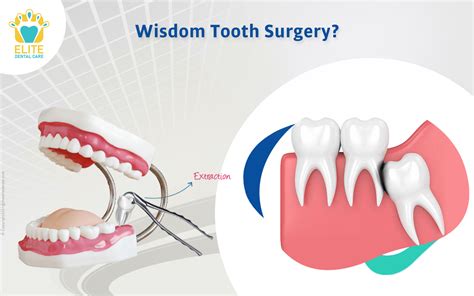 Is Wisdom Tooth Removal A Major Surgery Elite Dental Care