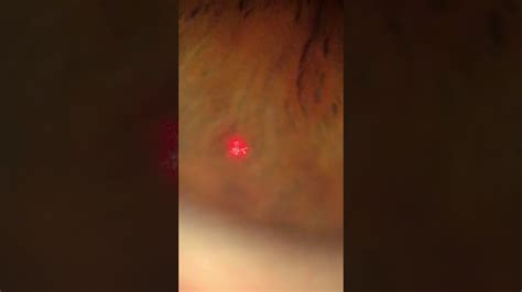 Iridotomy Yag Laser Angle Closure Glaucoma Mrechichi Md Phd Youtube