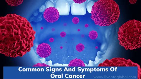 Common Signs And Symptoms Of Oral Cancer Livonta Global Pvt Ltd