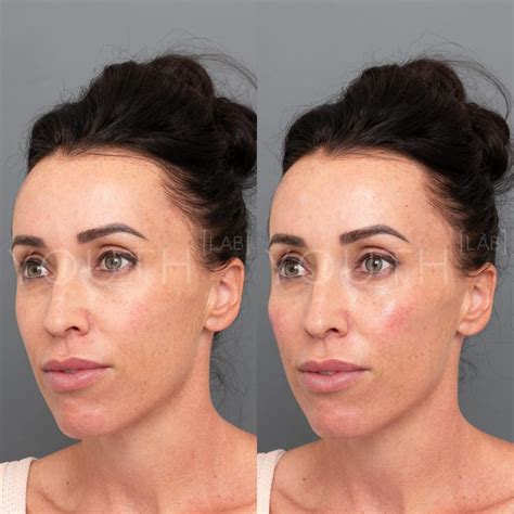 Face Volumetry Advanced Dermal Filler Cheek Jaw Chin Training