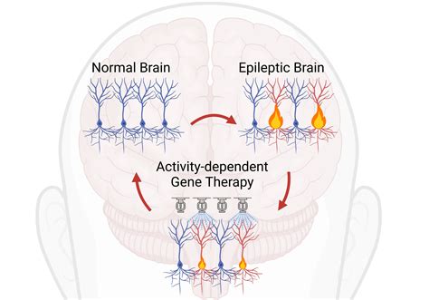 Gene Therapy Targeting Overactive Brain Cells Could Treat Neurological