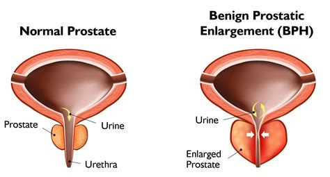 Innovative Urolift System To Treat Enlarged Prostate Now Available At United Hospital Center