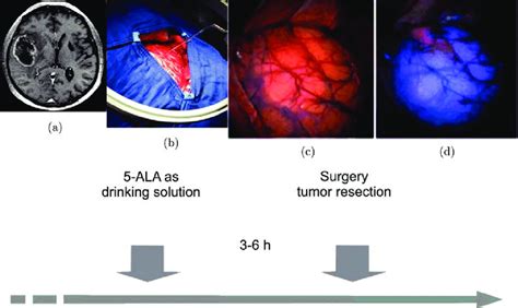 The °uorescence Guided Resection Of Glioblastoma In Patient