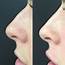 Non Surgical Nose Job  Injectable Rhinoplasty & Fillers