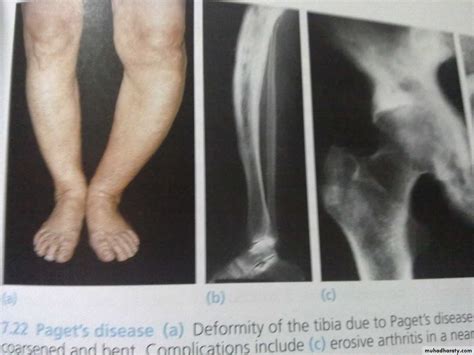 Metabolic Bone Disease Pptx محمود الجميلي Muhadharaty