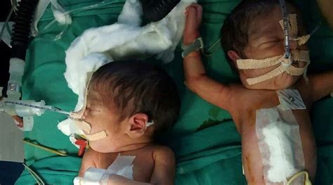 Surgeons Shared A Selfie After Successfully Performing Separation Surgery On 3 Day Old Conjoined