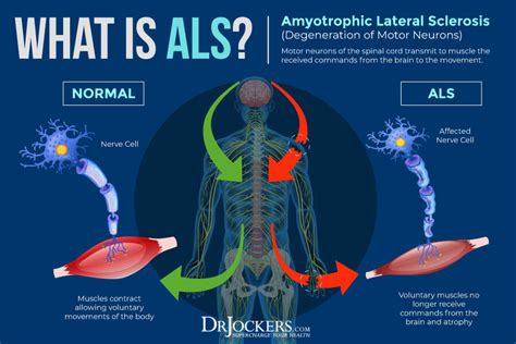 Als Symptoms Causes And Natural Support Strategies