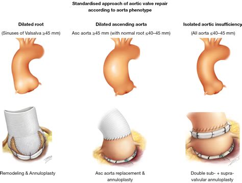 rationale for aortic annuloplasty to standardise aortic valve repair youssefi annals of