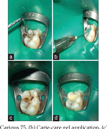 Chemomechanical Caries Removal Method Versus Mechanical Caries Removal