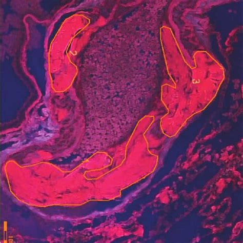 Cardiac Biopsy With Ttr Amyloid Positive For Ttr By Download