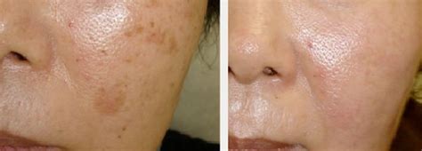 Before And After Microdermabrasion Removal Of Brown Age Spots On Face
