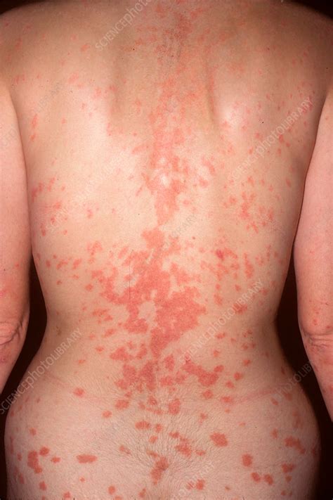 Guttate Psoriasis Stock Image C Science Photo Library
