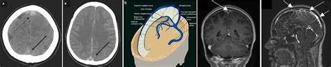 Cerebral Venous Thrombosis Cvt Emcrit Project