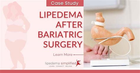 Weight Loss Surgery And Lipedema Lipedema Simplified