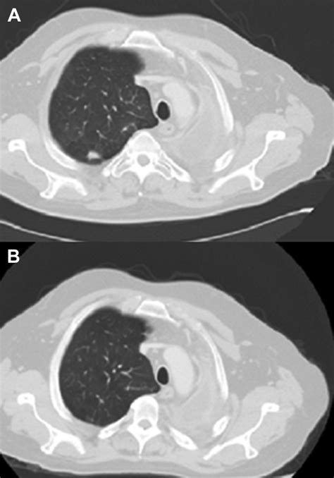 Alk Rearranged Squamous Cell Carcinoma Of The Lung Treated With Two