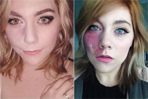 Woman Shows Off Facial Birthmark After Being Called Undateable