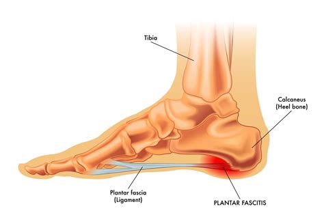How Do You Deal With Plantar Fasciitis Icy Tales
