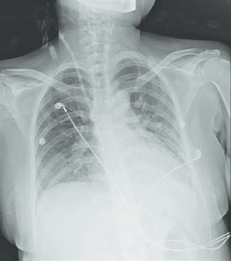 A Chest Radiograph Reveals Prominent Bilateral Vascular Markings
