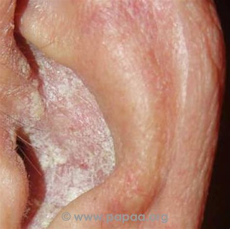 Pictures Of Psoriasis And Psoriatic Arthritis Papaa