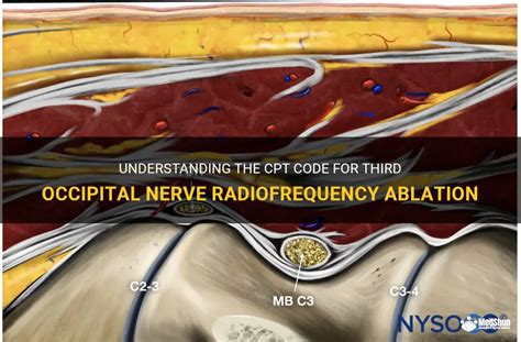 Understanding The Cpt Code For Third Occipital Nerve Radiofrequency