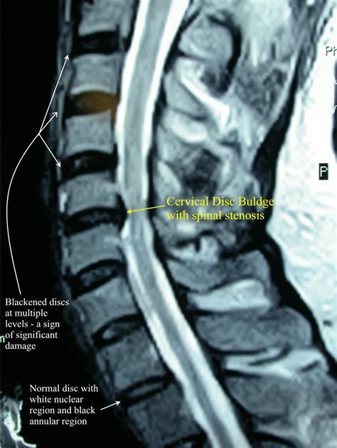 Cervical Spine Mri Herniated Disc