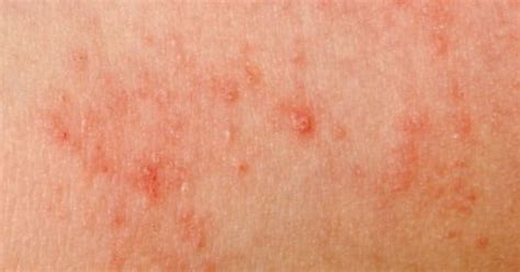 How To Identify Scabies Rashes That Look Like Scabies But Aren T