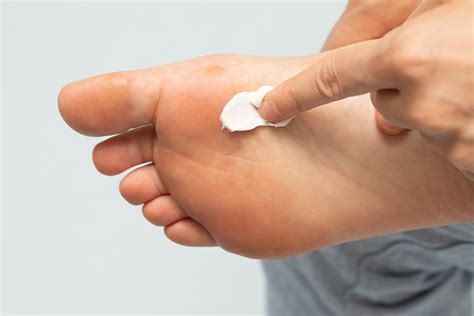 What Does Athletes Foot Look Like Celebration Foot And Ankle Institute