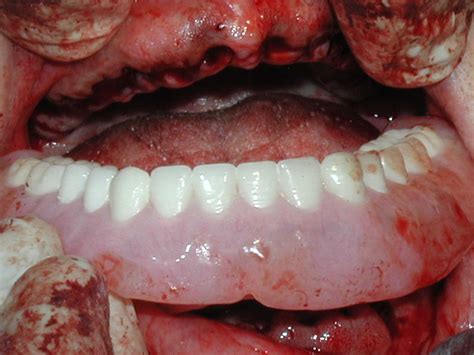 Immediate Full Lower Denture - Dr. Caputo | Palm Harbor Dentist