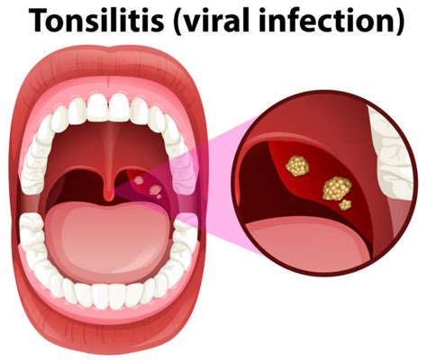 Pharyngitis Pic Illustrations Royalty Free Vector Graphics And Clip Art