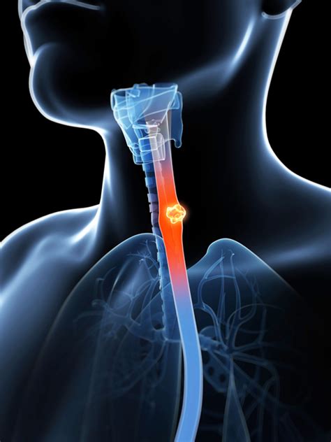 throat cancer symptoms take heed of these serious signs university health news