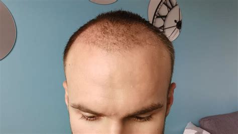 Hair Transplant Timeline Discover The Evolution Month By Month