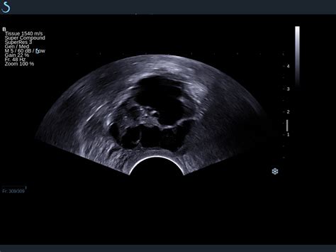 Ghim Trn Gynae Ultrasound