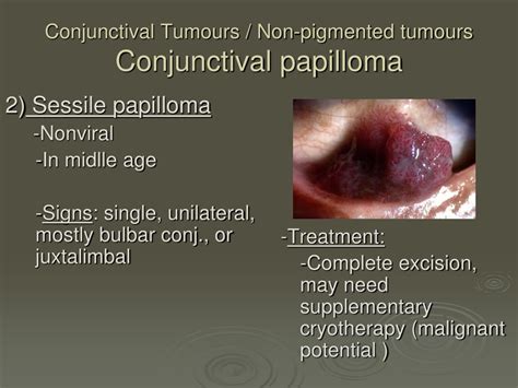 Ppt Ocular Tumors Powerpoint Presentation Free Download Id9102060