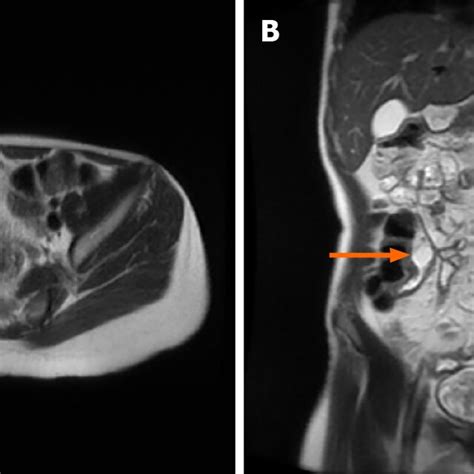 Magnetic Resonance Imaging Of Fibrostenosing Crohns Disease A Cross
