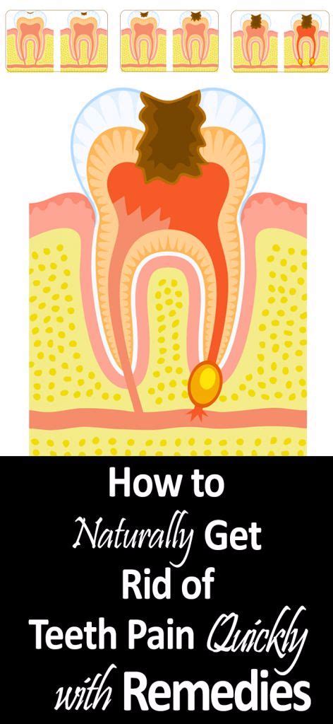 Natural Home Remedies For Toothache Lizy Style