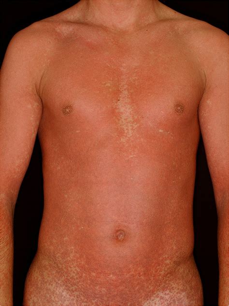 Amoxicillin Rash In A Patient With Infectious Mononucleosis Patient