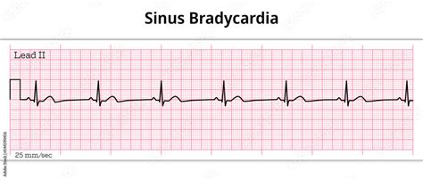 Ecg Sinus Bradycardia 8 Second Ecg Paper Vector De Stock Adobe Stock