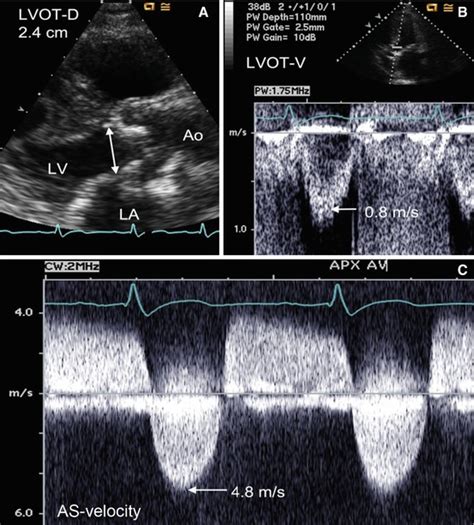 Ultrasound Imaging Of Calcific Aortic Valve Disease Radiology Key