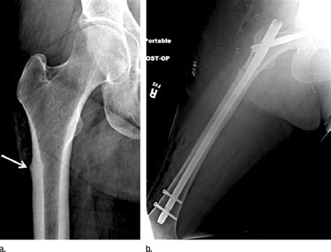 Radiographs Show Atypical Subtrochanteric Stress Fracture Of The Right