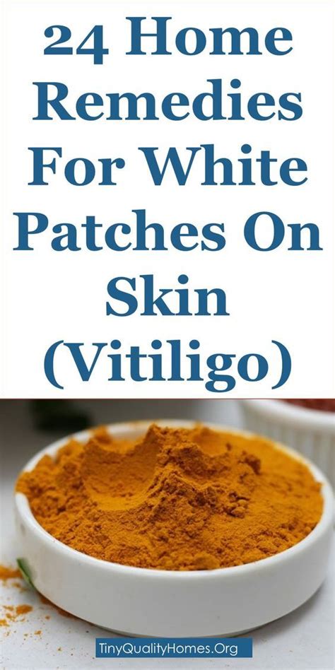 24 Home Remedies For White Spotspatches On Skin Vitiligo Vitiligo