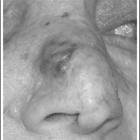 Pdf Primary Cutaneous Angiosarcoma On The Nose In A Patient With
