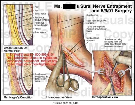 Medivisuals Sural Nerve Entrapment And Surgical Decompression Medical