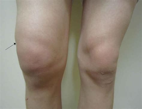 Joint Effusion Knee Joint Effusion Causes Diagnosis Treatment