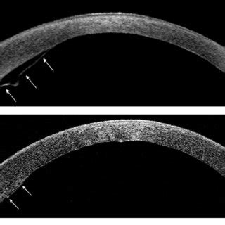 Representative Anterior Segment Optical Coherence Tomography Images