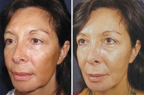 Patient 8348 Vi Peel Before And After Photos Peeling Skin Chemical