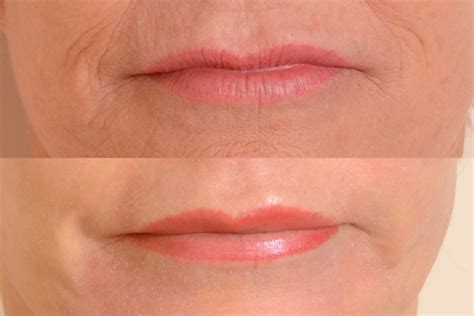 Lips And Area Around Mouth — Tahoe Aesthetic Medicine