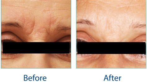 Laser Rejuvenation Resurface Roseneath Skin Clinic