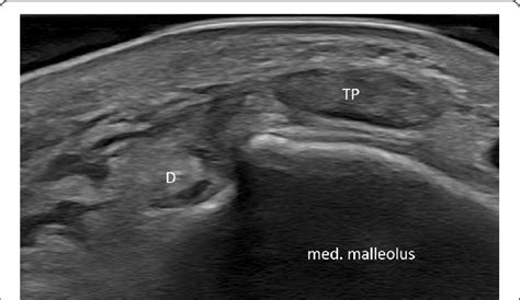 Ultrasound Of The Left Ankle Showing The Posterior Tibial Tendon Tp