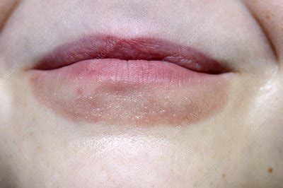 Lip Smacking Dermatitis Stock Image C016 6876 Science Photo Library